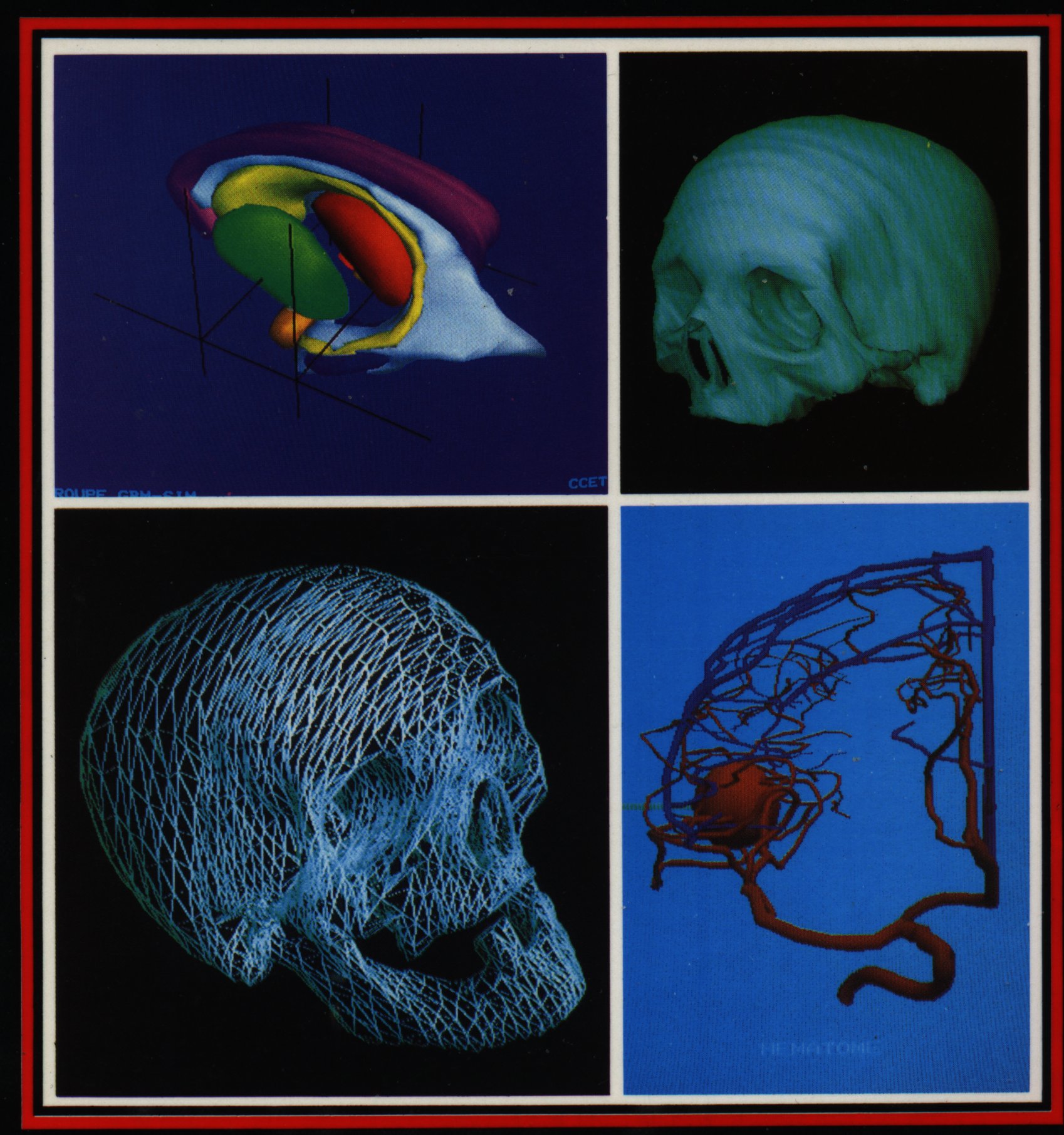 IMAGERIE MEDICALES 3D en 1984 IMAGERIE MEDICALES 3D en 1984